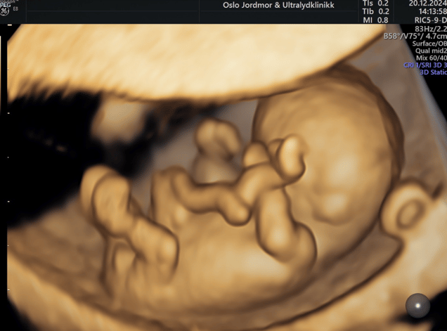 ultrasound week 11